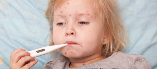 Osýpky sa môžu objaviť aj na Slovensku, najúčinnejšou prevenciou je očkovanie