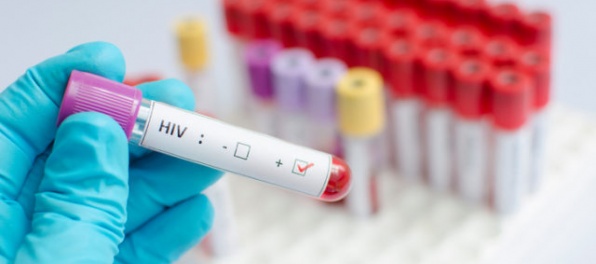 Vlani sa na Slovensku objavilo 87 nových prípadov nákazy HIV