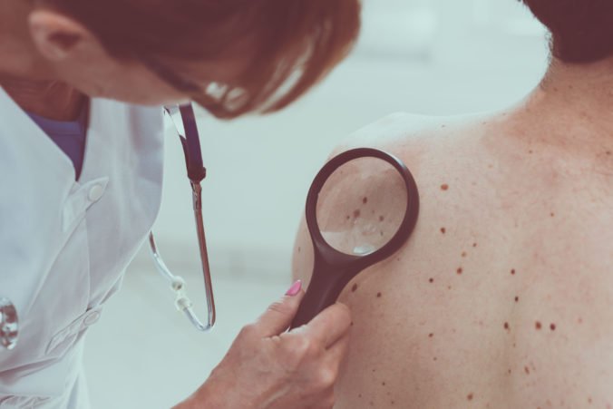 Preventívne vyšetrenie a konzultácia s odborníkom môže pomôcť odhaliť rakovinu kože