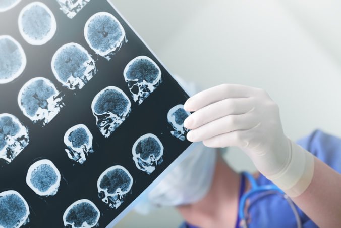 NÚDCH v Bratislave dobudoval neurocentrum, pacientov môžu operovať so špičkovou technikou