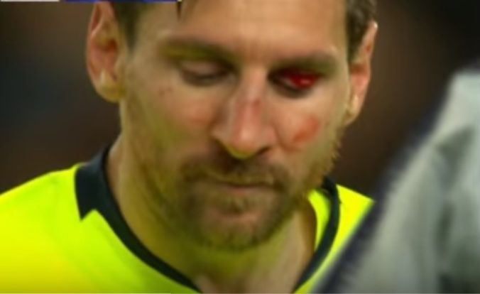 Video: Messi dohral zápas Ligy majstrov celý od krvi, mohol za to tvrdý úder od Smallinga