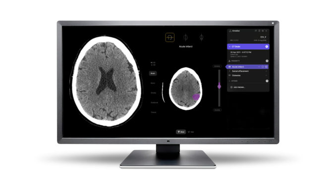 Unilabs s pomocou riešenia Annalise.ai poskytne pacientom inovatívne možnosti diagnostiky závažných prípadov CNS