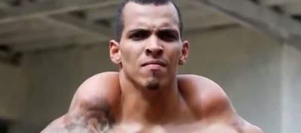 Mladý Brazílčan si vpichoval olej a alkohol do bicepsov, aby zvýšil objem svalov Mladý Brazílčan si vpichoval olej a alkohol do bicepsov, aby zvýšil objem svalov